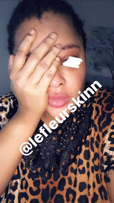 FACE AND LIP PEEL