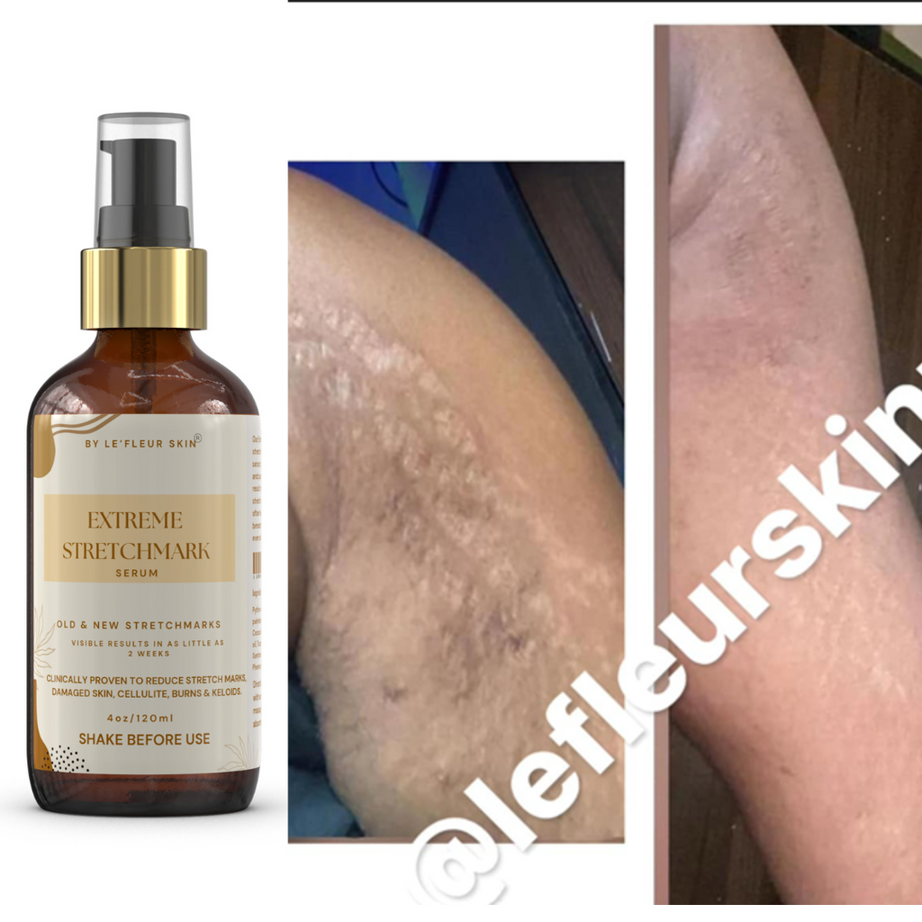 EXTREME STRETCHMARK SERUM - Lefleurskin