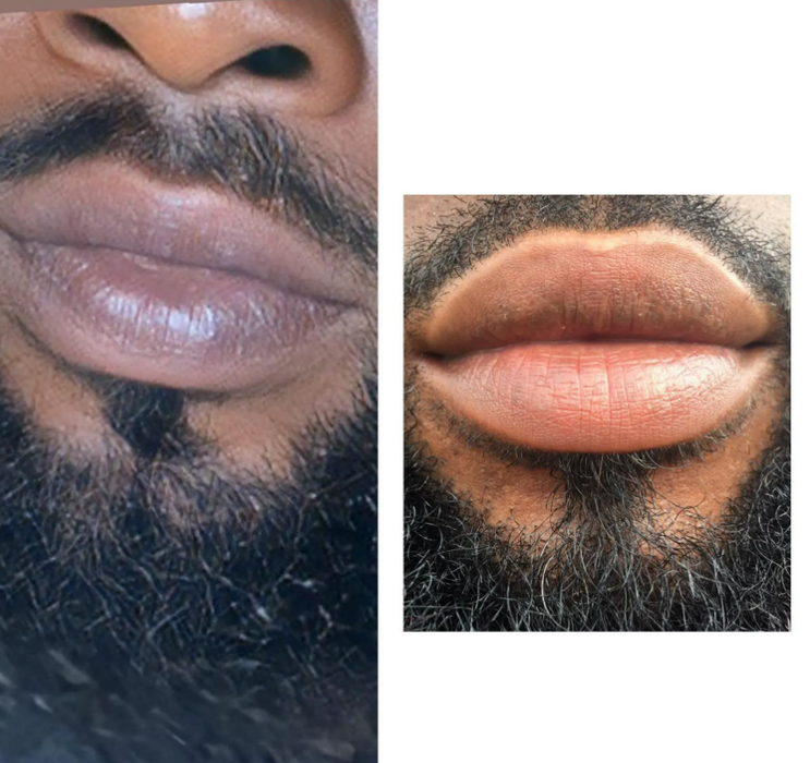 FACE AND LIP PEEL