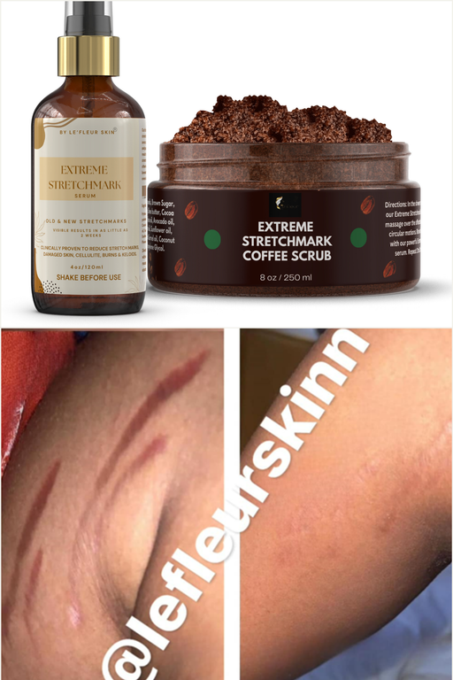 EXTREME STRETCHMARK SET