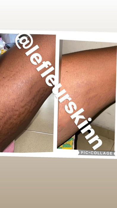 EXTREME STRETCHMARK SERUM