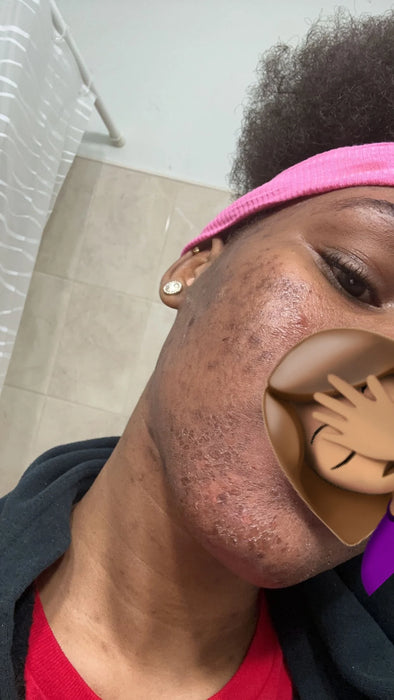 FACE AND LIP PEEL