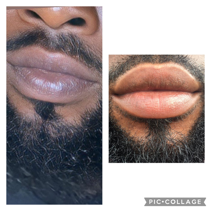EXTREME LIP DEPIGMENTATION SET