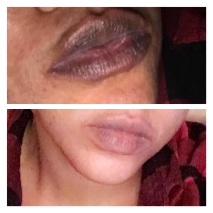 EXTREME LIP DEPIGMENTATION SET
