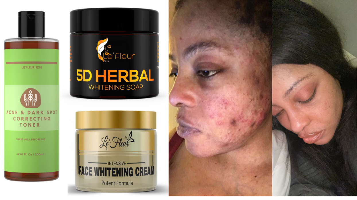 ACNE & DARKSPOT SET