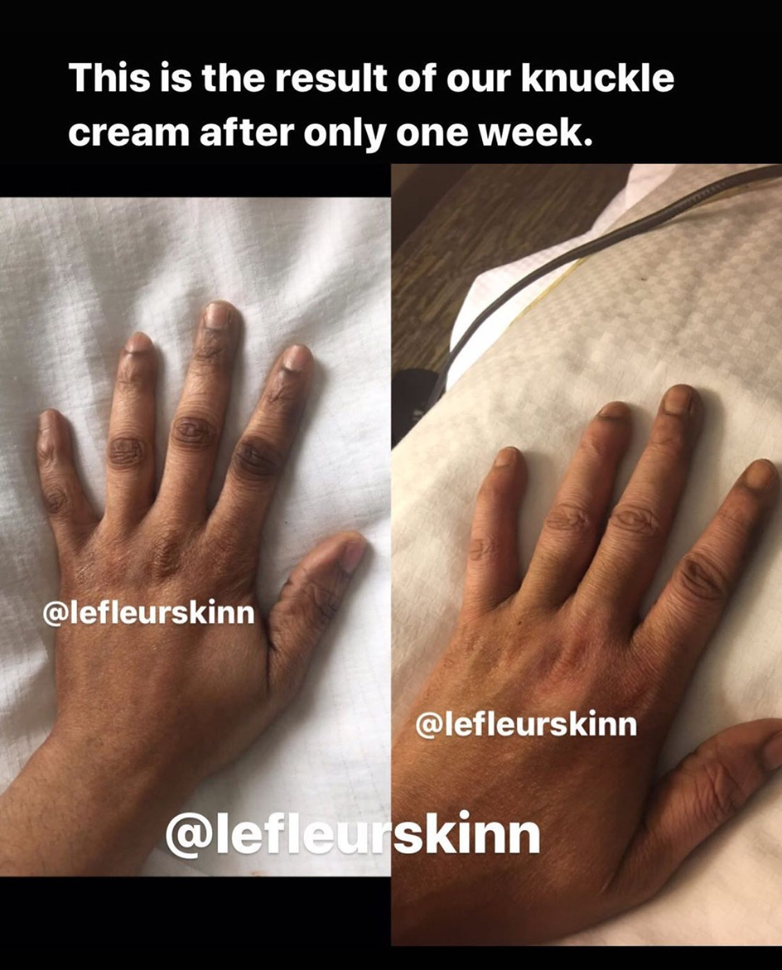 KNUCKLE ERASER CREAM Lefleurskin