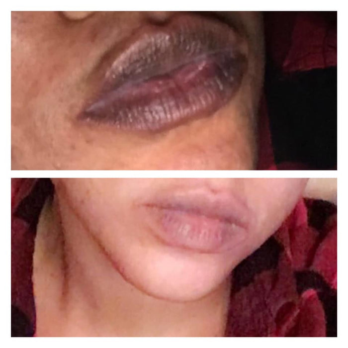FACE AND LIP PEEL