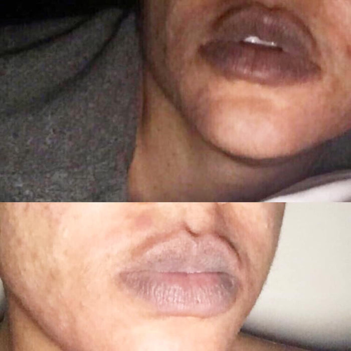 FACE AND LIP PEEL